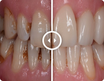 Before and After