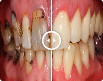 Before and After